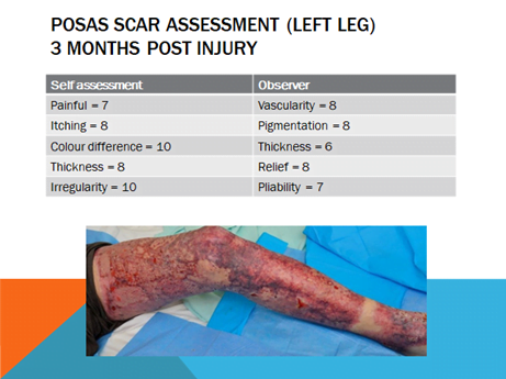 LymphaTouch Scarring Case Study 2
