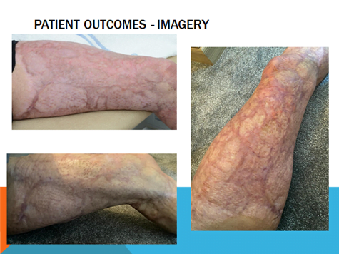 LymphaTouch Scarring Case Study 5