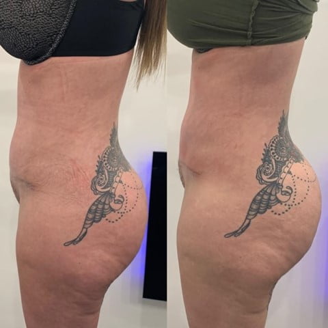 Photos showing the outcome from the LymphaTouch treatments